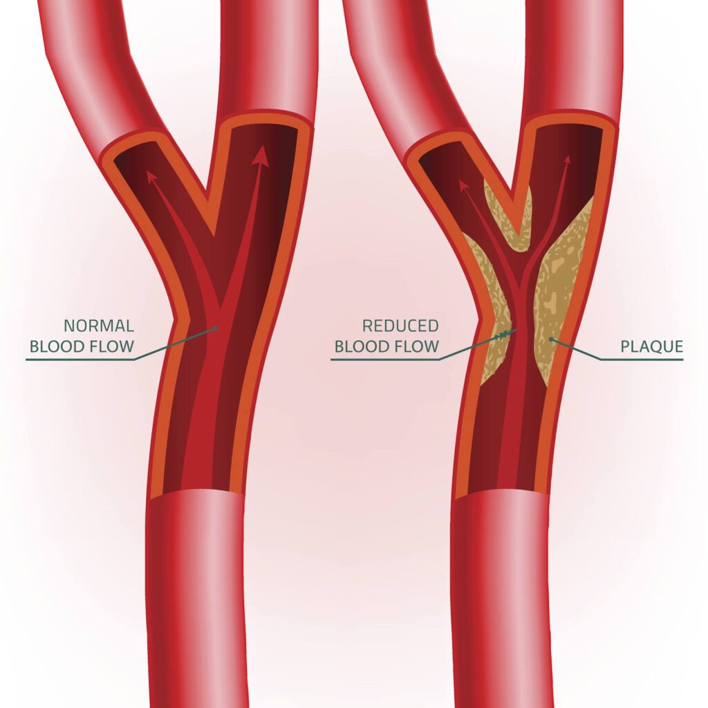 Blockage in the artery