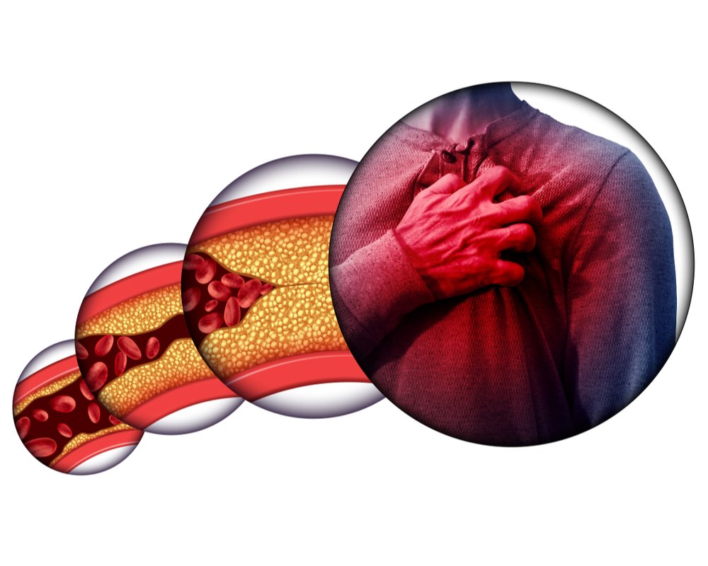 coronary artery disease prognosis