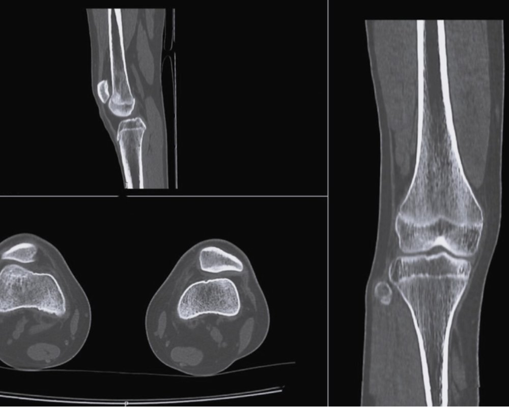 ct scan for fracture