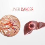 liver cancer