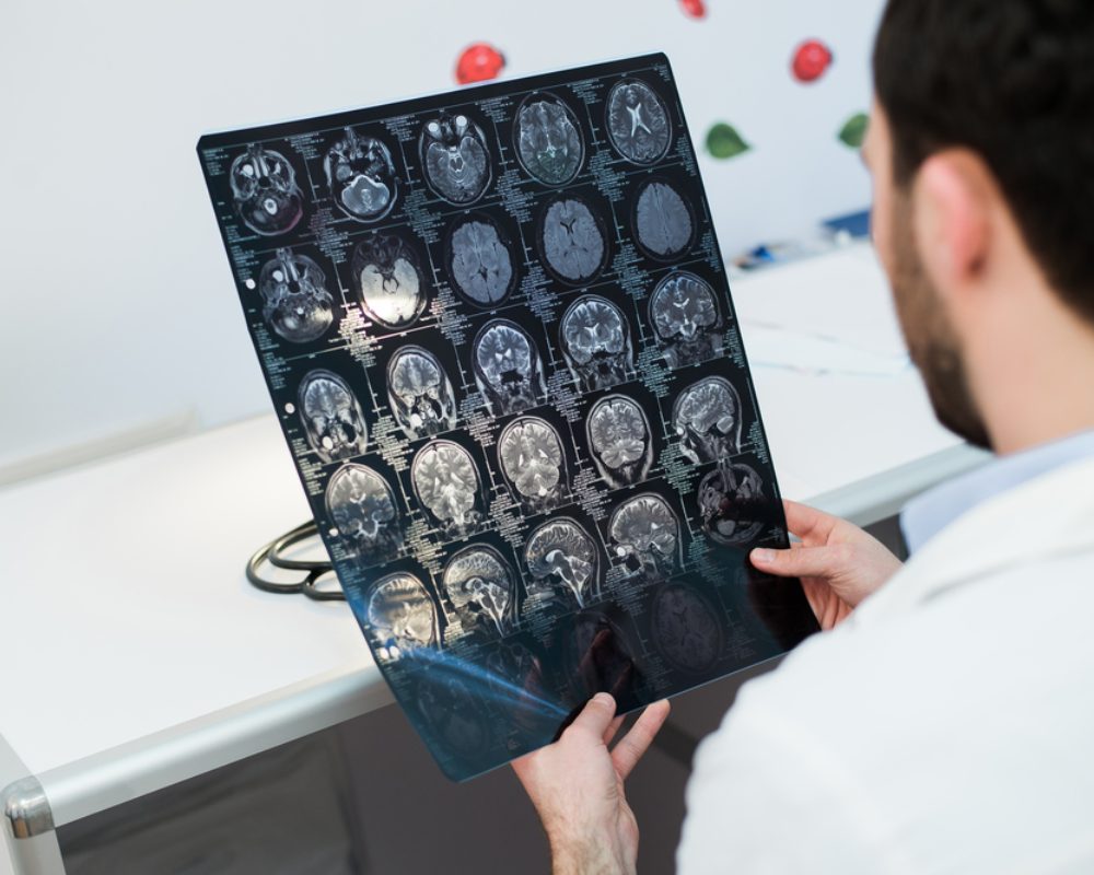 doctor-holding-an-adhd-brain-scan